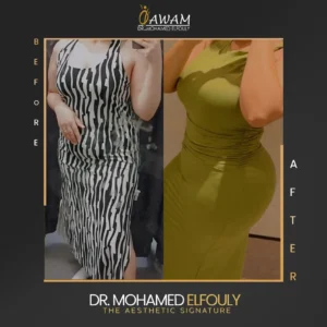 شد البطن قبل وبعد سيدات