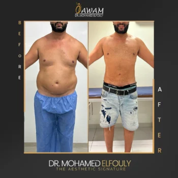 شفط دهون البطن قبل وبعد
