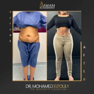 شفط دهون البطن قبل وبعد سيدات