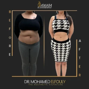 شفط دهون سيدات من الامام