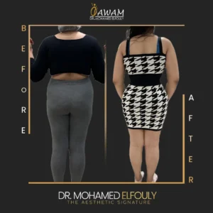 شفط دهون سيدات من الخلف